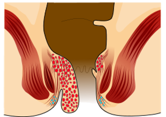 2nd 3rd degree piles