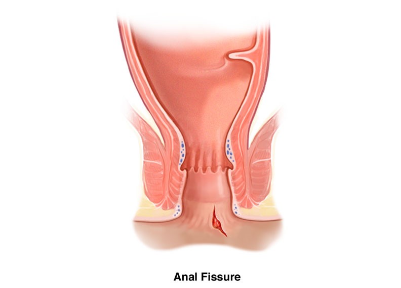 anal fissure