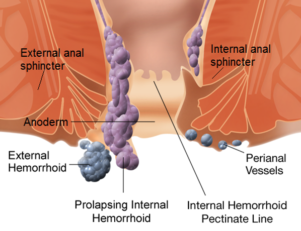 haemorrhoids